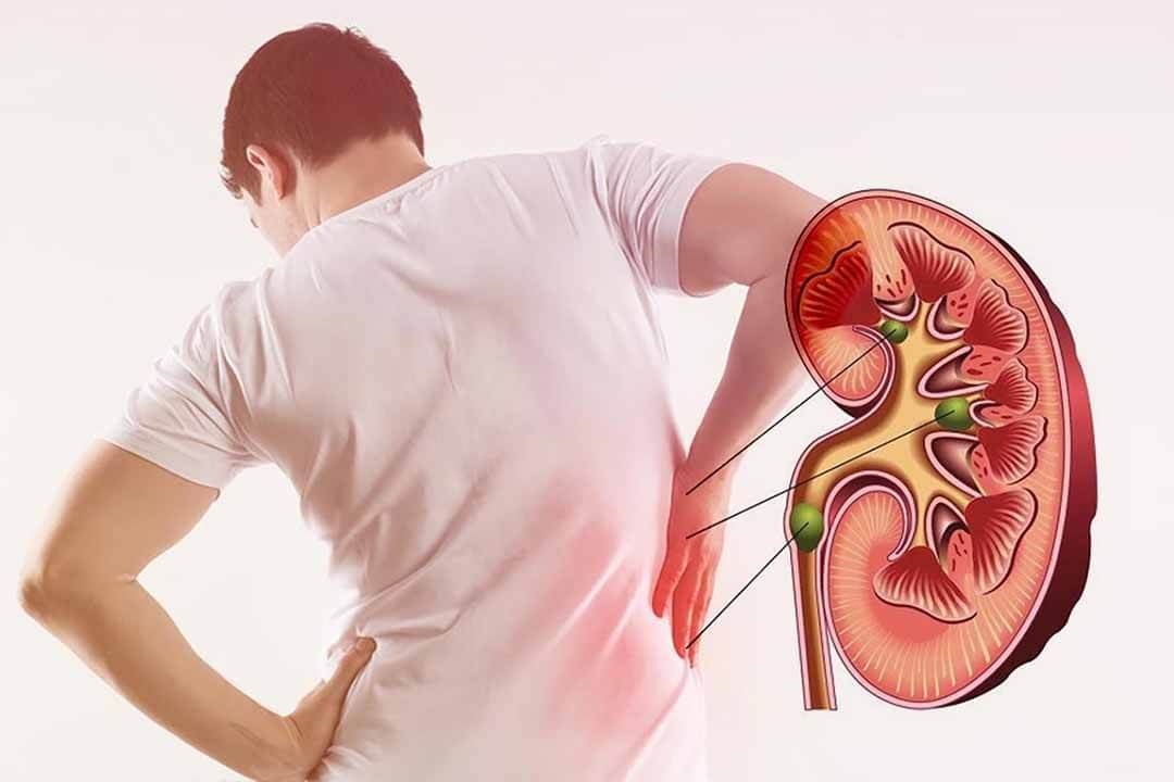 cách chữa bệnh sỏi thận tại nhà