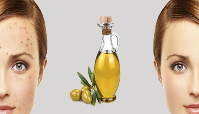 Trị mụn với dầu oliu