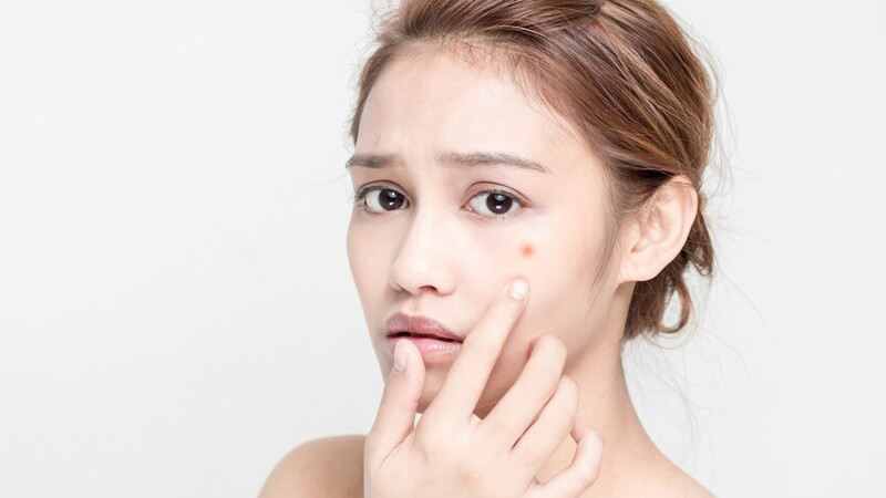 Không được tự ý nặn mụn vì dễ gây các tình trạng xấu hơn