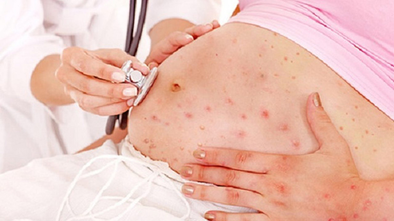 Da mụn là dấu hiệu của sự thay đổi nội tiết trong cơ thể