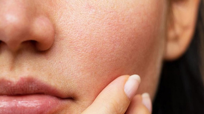 Làn da bị lão hoá gây ra tình trạng giãn mao mạch