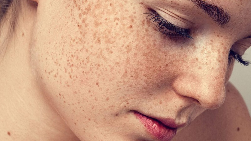 Da bị lão hoá dẫn đến tình trạng sắc tố da bị tổn thương