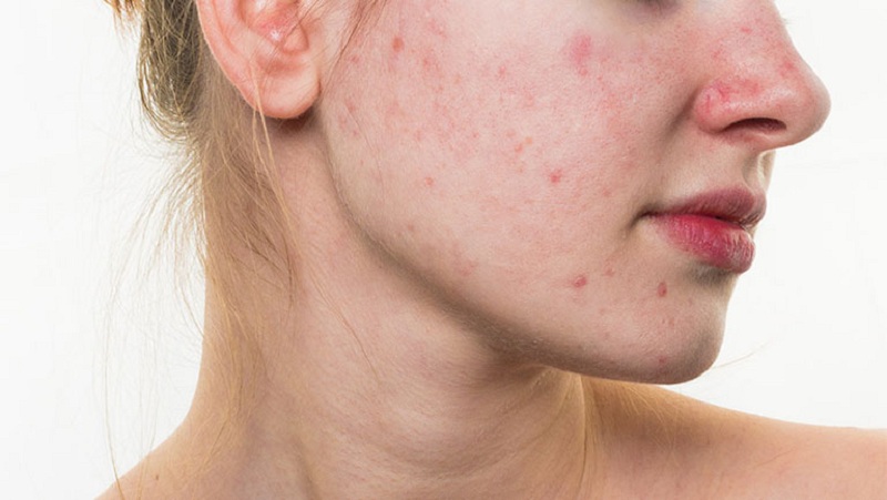 Cuộc sống hiện đại kéo theo nhiều tác nhân gây hại cho làn da mụn