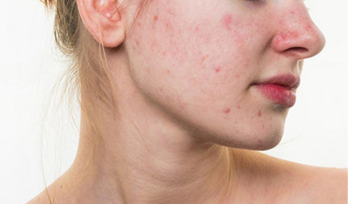 Mụn là kẻ thù số một của mẹ bầu