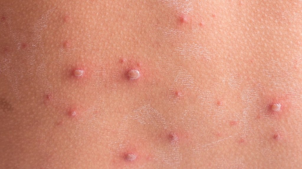 Bạn nên để các vảy nến tự động rụng