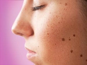           Chăm sóc da sau khi tẩy nốt ruồi bằng laser hết sức quan trọng