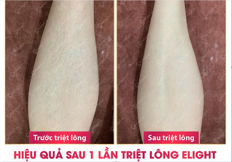 Kết quả triệt lông tại SeoulSpa.Vn