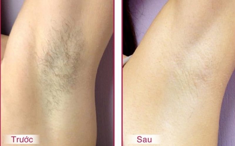 Công nghệ triệt lông bằng laser an toàn cho da