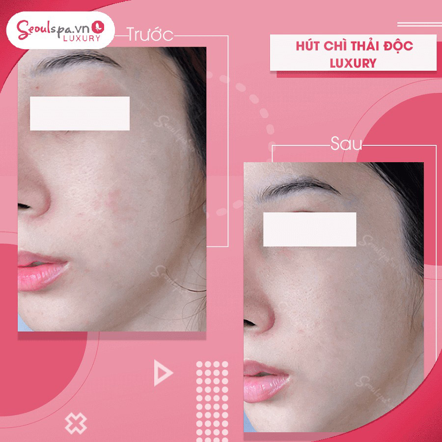 Seoul Spa là một địa chỉ chăm sóc sắc đẹp hàng đầu với nhiều năm kinh nghiệm cung cấp dịch vụ làm đẹp.