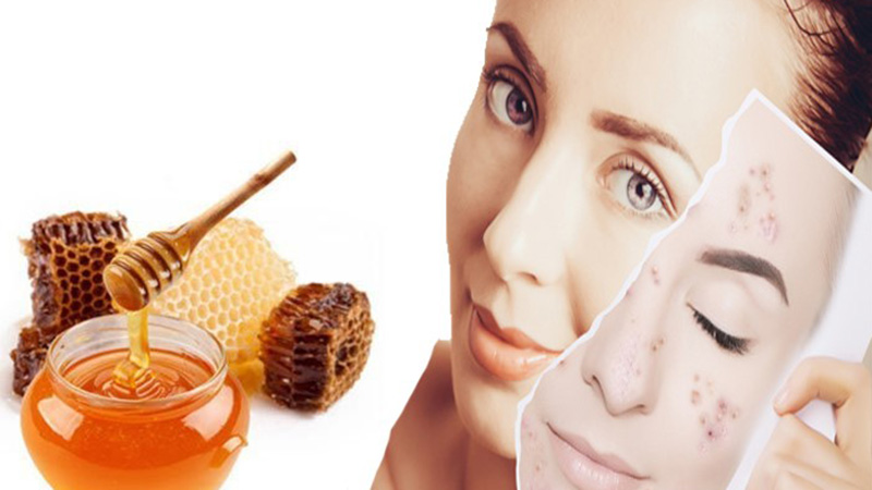 Mật ong cách trị mụn hiệu quả