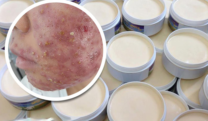 Mỹ phẩm không rõ nguồn gốc gây tổn thương da nghiêm trọng