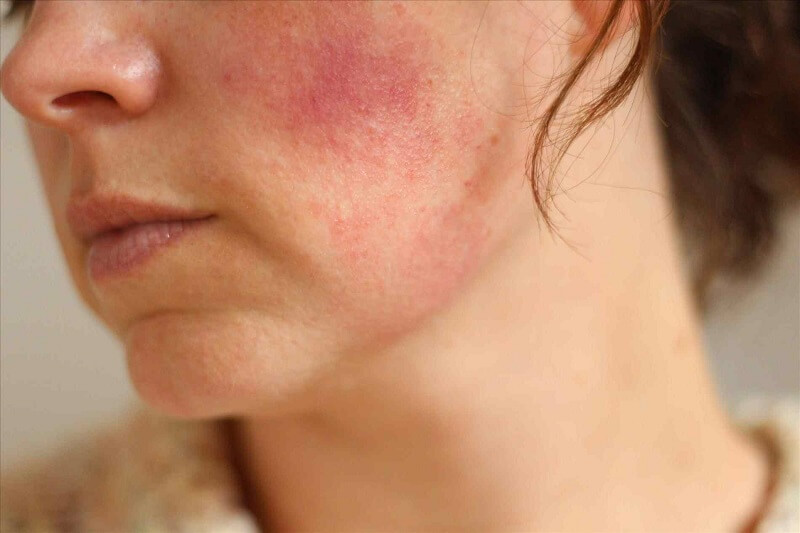 Da mặt mỏng nổi mạch máu rất dễ kích ứng