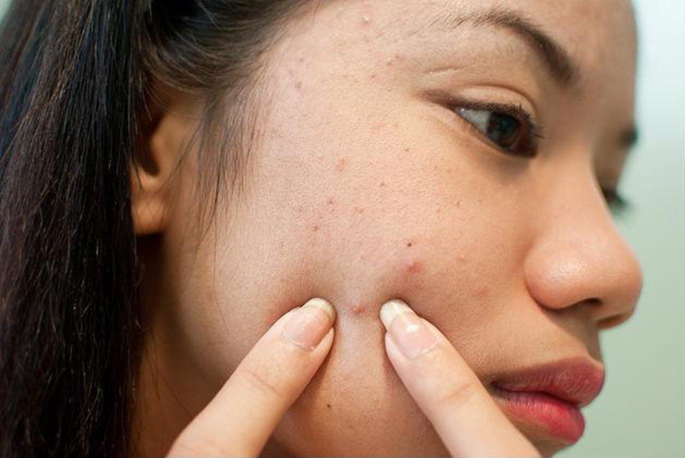 Tự ý nặn mụn không đúng cách sẽ làm tình trạng mụn càng thêm nặng