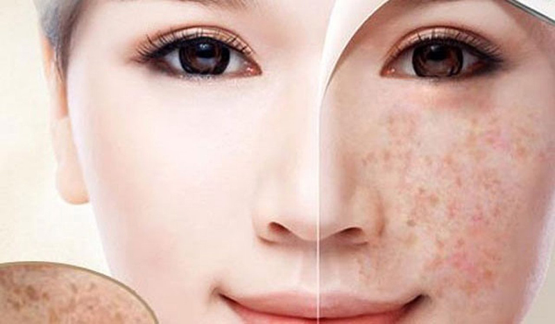 Kem trị nám Hàn Quốc làm bật tone rõ rệt