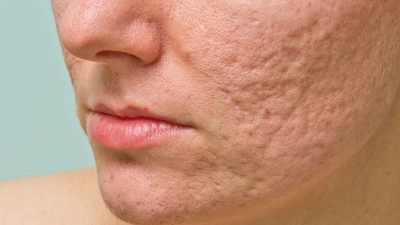 Sẹo rỗ có tự hết không là thắc mắc của nhiều người