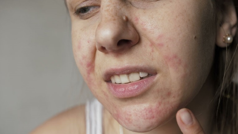 Dị ứng với mỹ phẩm khiến da nổi mụn trứng cá