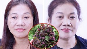 Dùng lá tía tô để trị nám cực kỳ hiệu quả