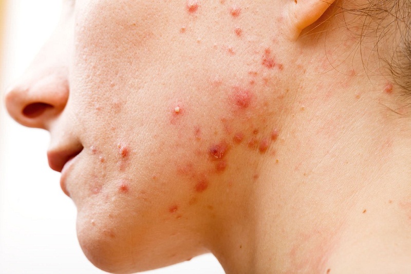 Chế tạo kem dưỡng ẩm tại nhà sai tỷ lệ khiến da lên mụn khi sử dụng