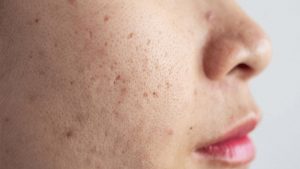 Nếu không chữa trị sớm, mụn ẩn sẽ khiến mặt bạn có nhiều sẹo rỗ.