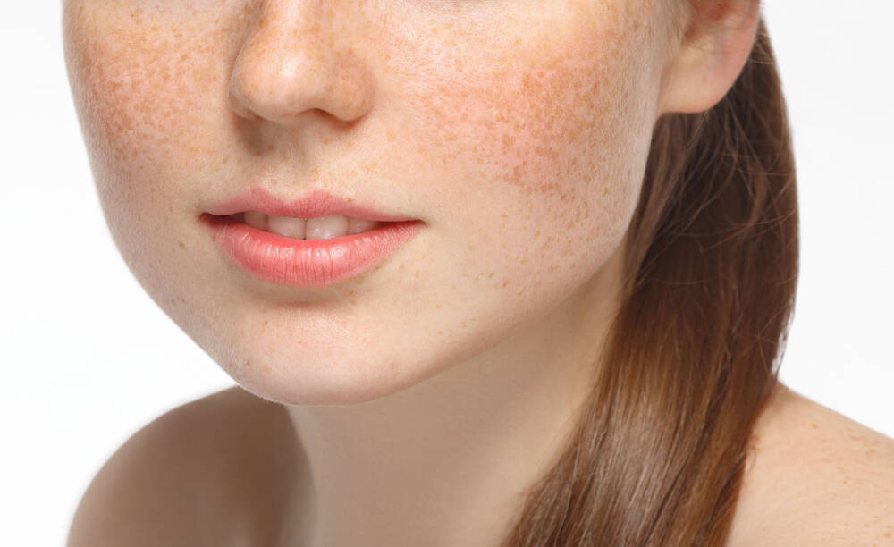 Nám là một loại bệnh lý da do sắc tố melanin tích tụ quá nhiều