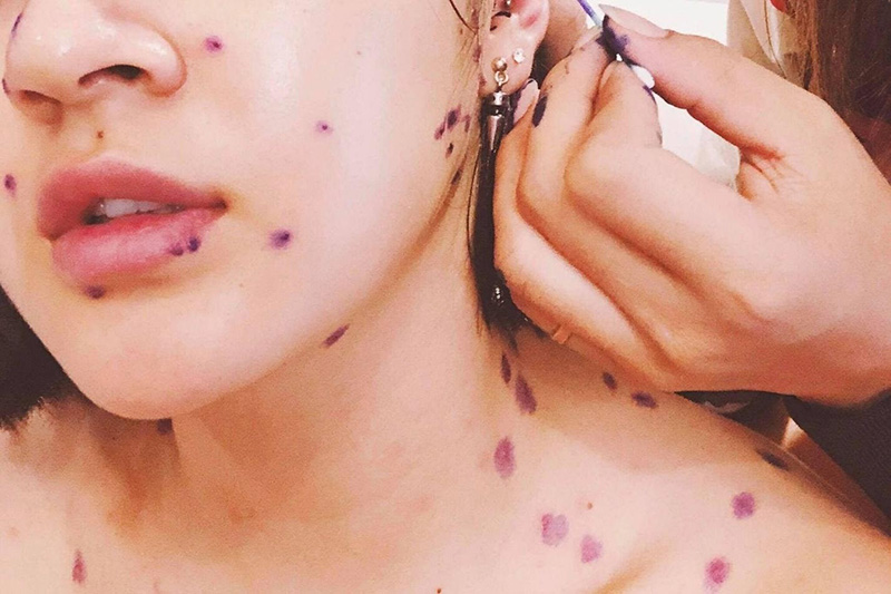 Cách điều trị sẹo rỗ do thủy đậu gây nên