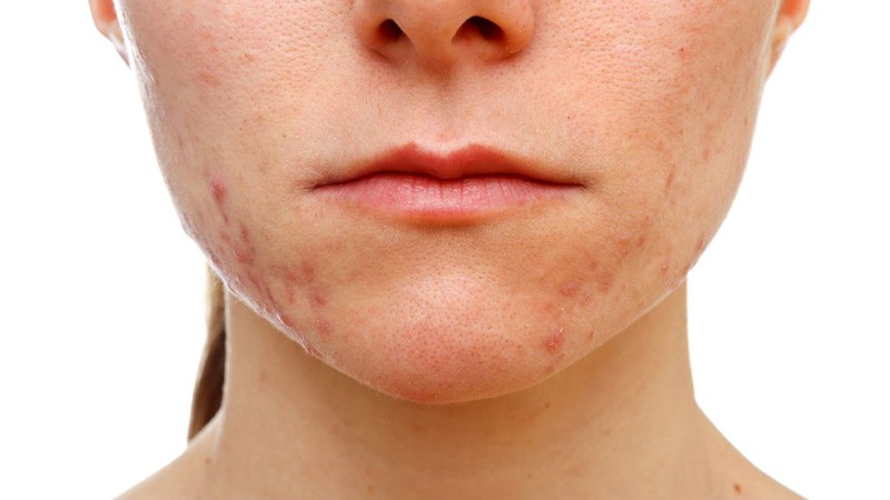 Da bị mụn thường tiết nhiều dầu và bị khô