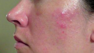 Mụn bọc là mụn trứng cá phát triển nặng hơn