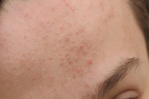 Tình trạng mụn viêm do tuyến bã nhờn tắc nghẽn gây viêm