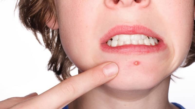 Mụn bọc gây viêm nhiễm nặng nề, rất nguy hiểm