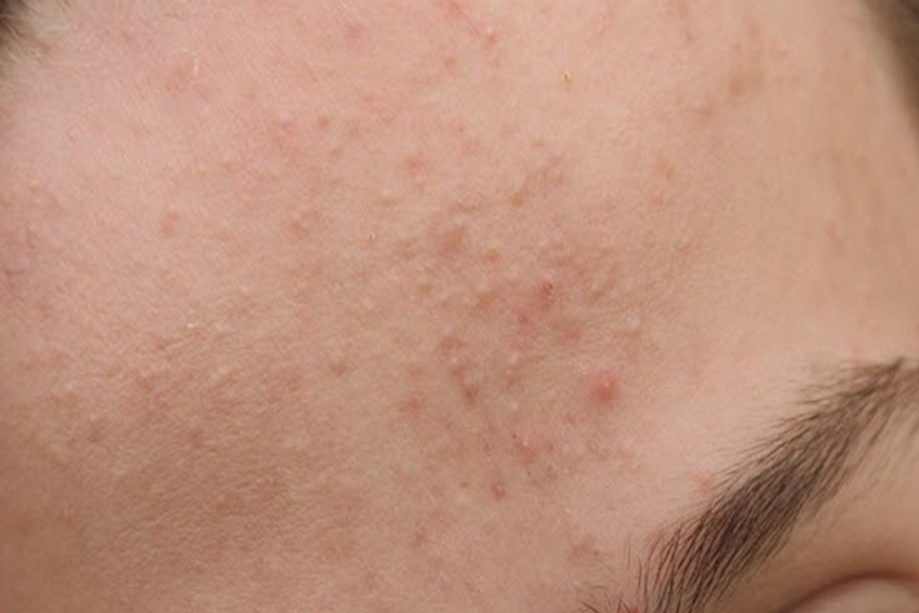 Mụn ẩn rất khó nhìn thấy mắt, chỉ cảm nhận rõ khi sờ vào