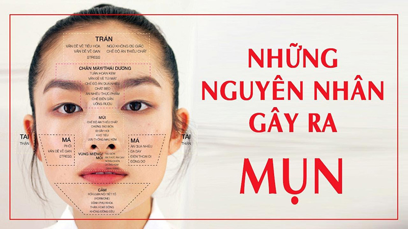 Nguyên nhân hình thành mụn