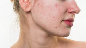 Quy trình skincare cho da mụn hằng ngày