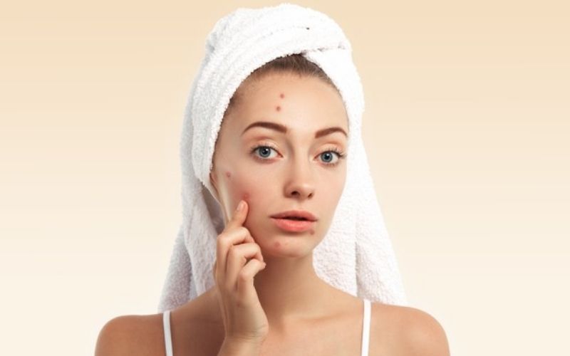 Da dầu mụn làm mất thẩm mỹ khuôn mặt