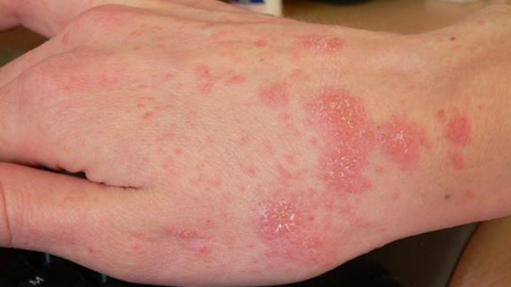 Nấm da là bệnh lý về da thường gặp ở môi trường kém vệ sinh