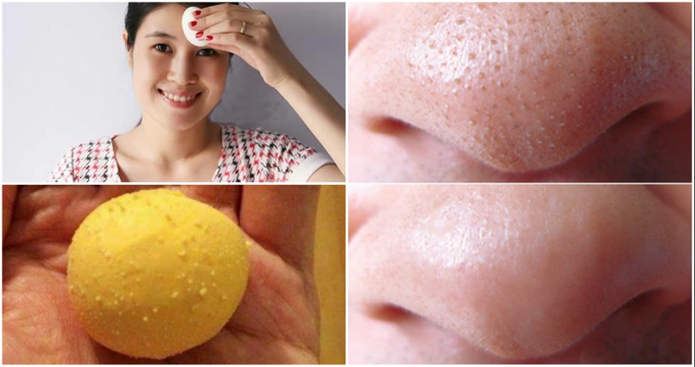 Trị mụn bằng trứng gà luộc đơn giản nhưng hiệu quả bất ngờ