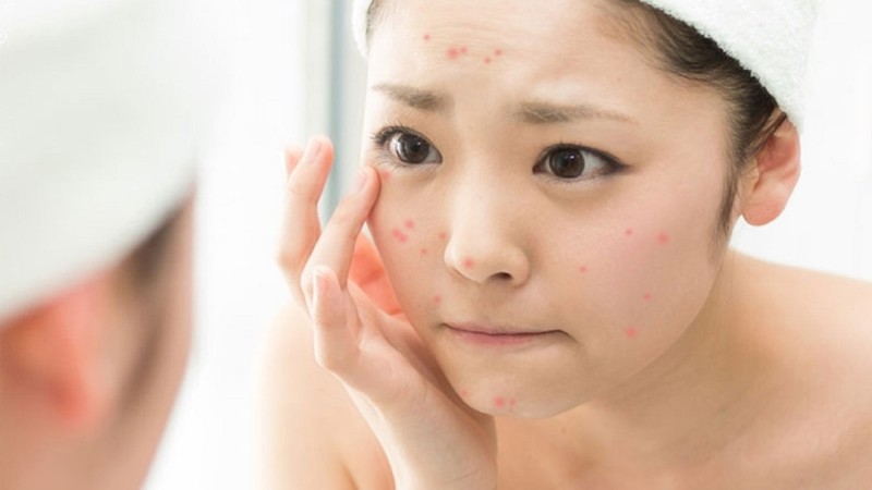 Trứng gà có công dụng trị mụn cực kỳ thần thánh ít người biết